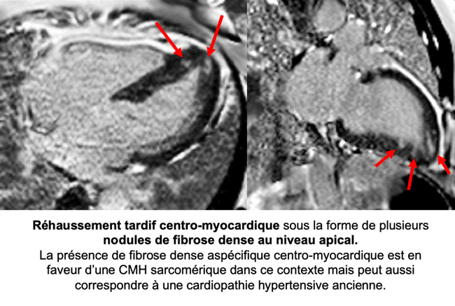 Figure 4 : Séquence de Réhaussement tardif Coupes long-axe 4 cavités et 2 cavités
