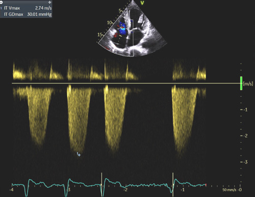 Exemple de pressions de remplissages élevées chez un patient avec amylose cardiaque : E/A >2, E/E’ moyen = 13, volume biplan indexé de l’OG > 34 ml/m² SC, Vmax de l’IT proche de 2.8 m/s