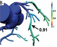 Scanner coronaire de perfusion et FFR-CT - Figure 3b