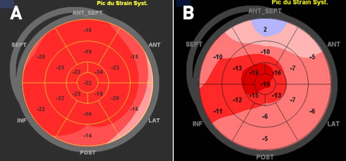 Figure 2: Anomalie des strains régionaux observables en cas de maladie de Fabry