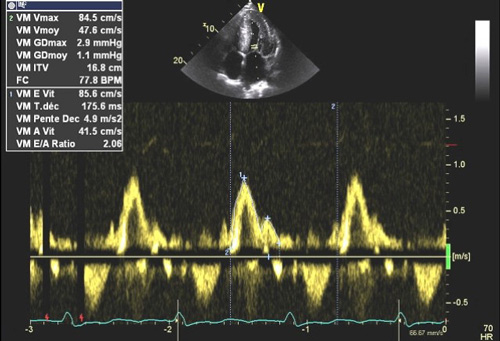 Figure 2 : Pressions de remplissage VG élevées souvent élevées en cas d’amylose cardiaque évolutive