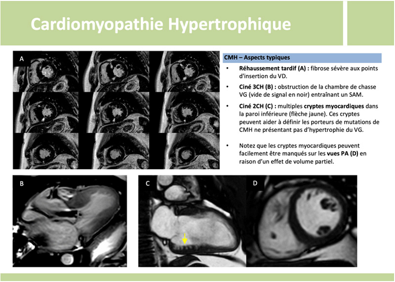 Cardiomyopathie Hypertrophique -  CMH - Aspects typiques
