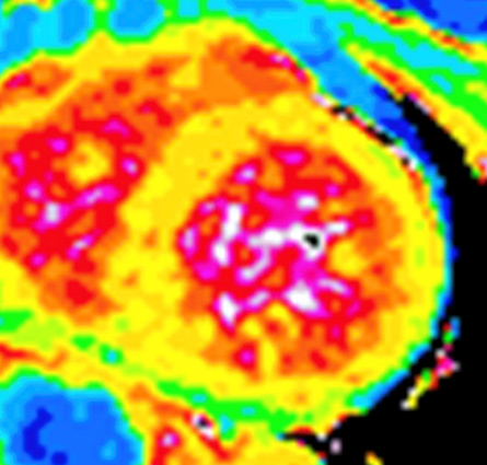 Figure 7 : Cartographie de T1 mapping en IRM en cas d’amylose cardiaque