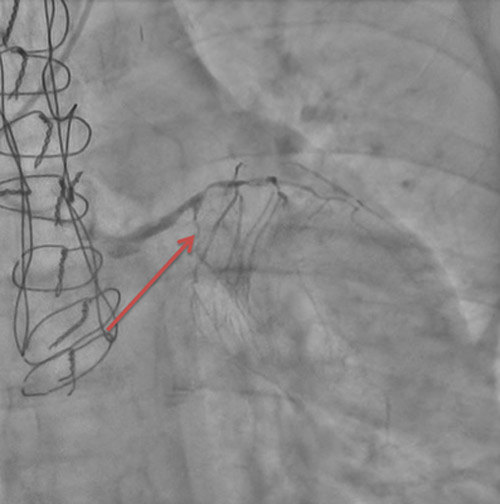 Image 2 : occlusion chronique de la circonflexe proximale