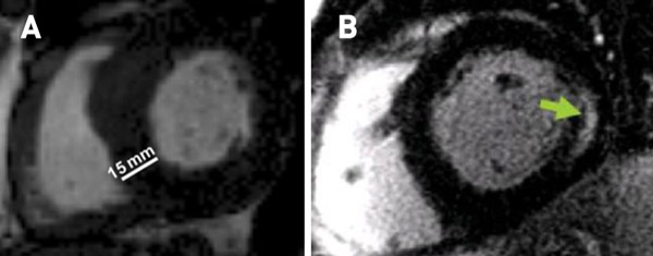 Figure 1 : IRM cardiaque en cas de maladie de Fabry