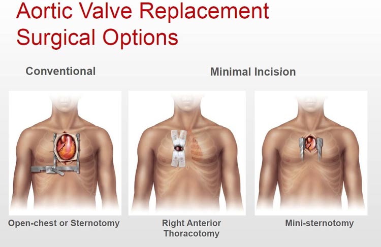 Aortic valve replacement surgical options