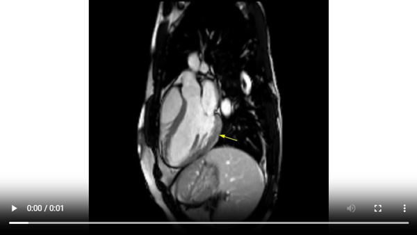 Visualisation rehaussement myocardique systolique - 3 cavités
