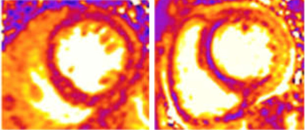 imagerie-cardiaque-cas-clinique-en-direct-de-Lariboisiere-sequence-t2-mapping