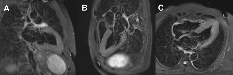 Figure 2 : Séquence T2 STIR, coupes 2 cavités (A) 3 cavités (B) et 4 cavités (C)