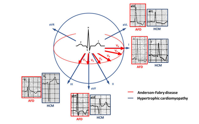 Figure : ECG dans la maladie de Fabry avec HVG et dans la CMH sarcomèrique