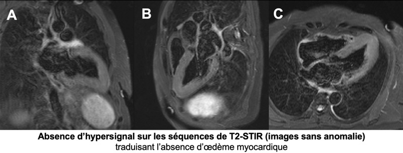 Figure 2 : Séquence T2 STIR, coupes 2 cavités (A) 3 cavités (B) et 4 cavités (C)