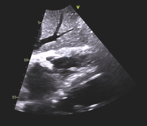 b- Hypertrophie VD mesurée à 9 mm en incidence sous-costale