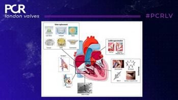 PCR London Valves : Traitement percutané de la valvulopathie tricuspide