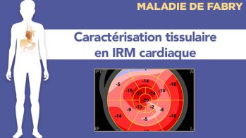 Utilité de la caractérisation tissulaire en IRM cardiaque en cas de CMH ou d’HVG inexpliquée