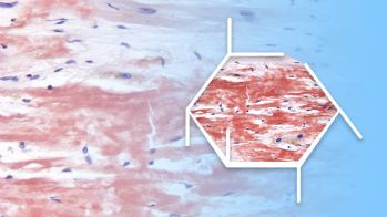 La FA est un facteur prédictif de mortalité dans l’amylose cardiaque ATTR