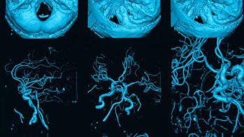 Hématome sous-dural chronique : bénéfices de l'embolisation de l'artère méningée moyenne avec de la colle biologique