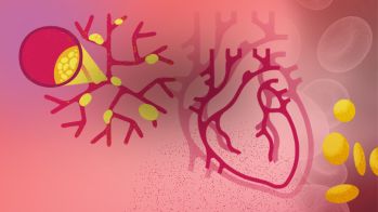 Effets de l’alirocumab sur la charge athéromateuse coronaire dans l’hypercholestérolémie familiale