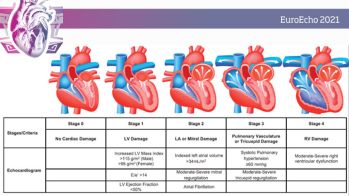 Place de l’évaluation des atteintes cardiaques extravalvulaires dans le bilan des valvulopathies