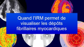 Quand l'IRM permet de visualiser les dépôts fibrillaires myocardiques