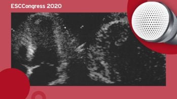 Apixaban : efficace et plus sur que les AVK en cas de thrombus ventriculaire gauche (VG) post-infarctus