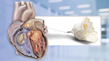 EuroPCR 2021 : traitement percutané de l’insuffisance mitrale
