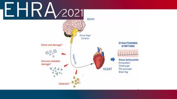 EHRA 2021 : prévalence de la tachycardie sinusale inappropriée chez les patients avec syndrome post Covid-19