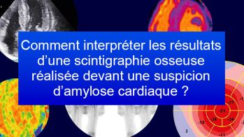 Comment interpréter les résultats d’une scintigraphie osseuse réalisée devant une suspicion d’amylose cardiaque ?