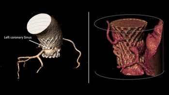 Deux ans après un TAVI : le silence du sinus coronaire gauche