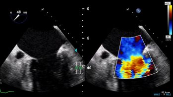 Valvulopathies : les recommandations ESC en un cas clinique