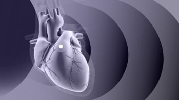EARLY TAVR : repenser l'indication du TAVI chez les patients asymptomatiques