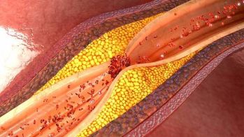 Resténose intra-stent: résultats prometteurs pour un ballonnet recouvert de biolimus par rapport à un ballonnet au paclitaxel