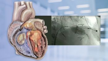 EuroPCR 2021 : perspective dans le traitement percutané de l’insuffisance tricuspide