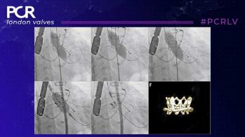 PCR London Valves : Intérêt de la « Fracture » de bioprothèse dans le cadre de TAVI Valve in Valve