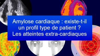 Amylose cardiaque : existe-t-il un profil type de patient ? Les atteintes extra-cardiaques