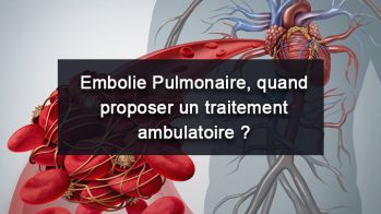 Embolie pulmonaire – Quand proposer un traitement ambulatoire ?