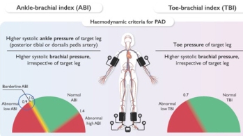 Artériopathie oblitérante des membres inférieurs : les recommandation ESC