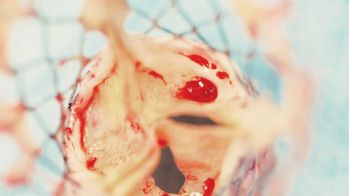 Quelles options pour le patient TAVI ?