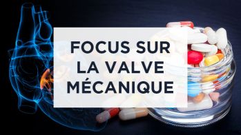 AOD et valve mécanique