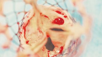 Valve aortique percutanée vs chirurgie chez les patients à risque intermédiaire : résultats équivalents à 5 ans