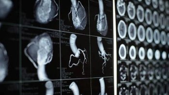 Mesurer le score calcique coronaire chez des personnes de la tranche d'âges 30-45 ans pourrait avoir un intérêt pour identifier une sous-population de personnes dont le risque cardiovasculaire dans les 30 ans qui suivent est augmenté et qui pourraient bénéficier de stratégies de prévention, selon une étude publiée par le JAMA Cardiology.