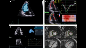 Fuite tricuspide : les retentissements sur le coeur