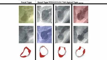 Syndrome de Tako-Tsubo : recommandations/consensus ESC 2018