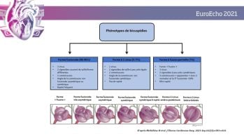 Classification des bicuspidies aortiques et aortopathies : utilisation d’un même langage 