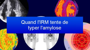 Quand l'IRM tente de typer l'amylose