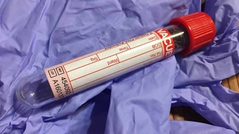Diagnostic de l'infarctus : le seuil de troponine I ultrasensible recommandé est inadapté à une population hospitalière