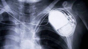 Intérêt potentiel d'un défibrillateur implantable dans des insuffisances cardiaques actuellement non éligibles