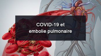 COVID-19 et embolie pulmonaire