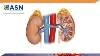 Empagliflozine : réduction du risque cardiovasculaire et rénal en cas d’IC à fraction d’éjection réduite quel que soit le niveau de fonction rénale à l’inclusion