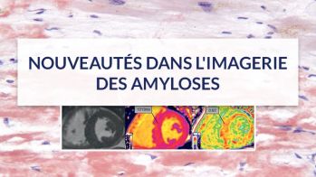 Association amylose cardiaque et rétrécissement aortique, comment diagnostiquer l'amylose et comment traiter la valve ? 