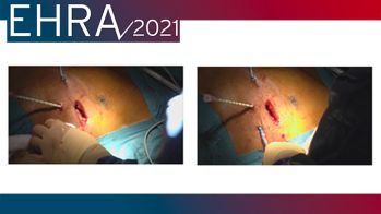 EHRA 2021 : situations difficiles pour l’ablation de tachycardie ventriculaire